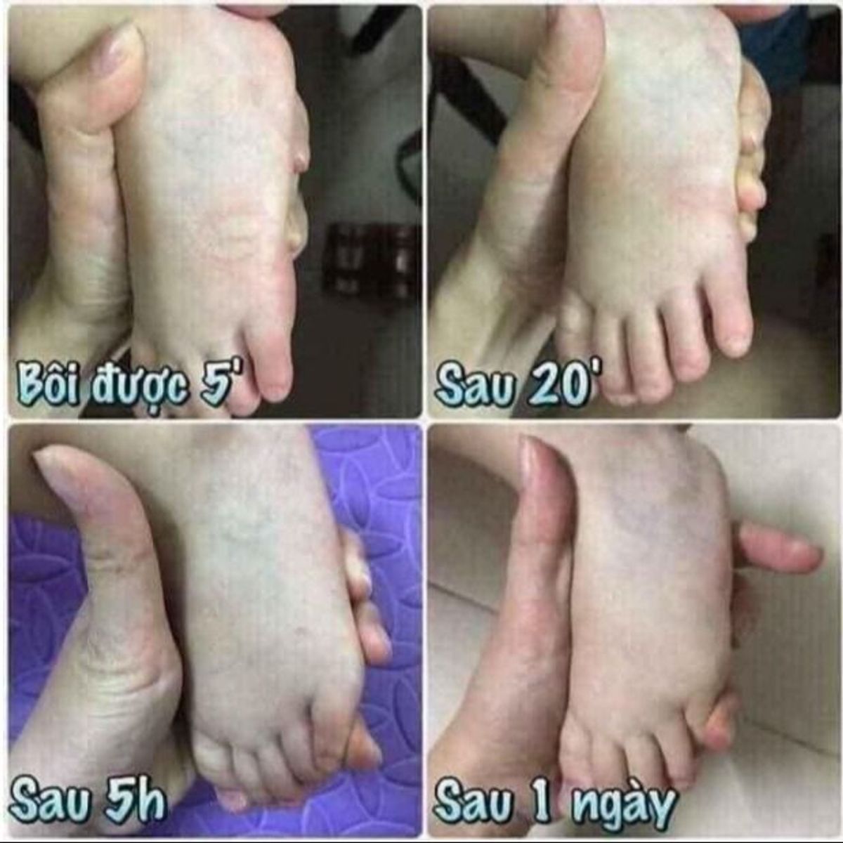 KEM BÔI MUỖI TRẺ EM HÀNG CHUẨN THÁI LỌ 13G CTB447 - BECHIP KEM BÔI MUỖI TRẺ EM HÀNG CHUẨN THÁI LỌ 13G CTB447 - BECHIP