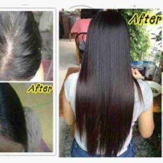 Bộ dầu gội trị hói đầu kích mọc tóc xiêu tốc