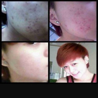 Sirum trị mụn my miu