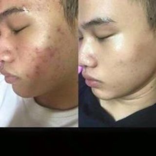 Kem chấm mụn khổ qua