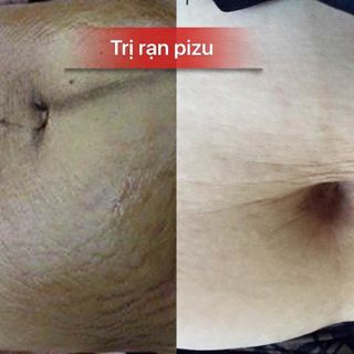 Dầu trị rạn