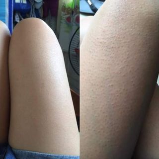 Bột tắm trị viêm lỗ chân lông