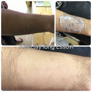 Triệt lông essovi