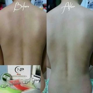 Tắm trắng nellyp