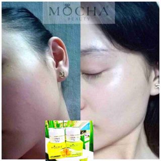 Bộ trị mụn thâm đông y mocha