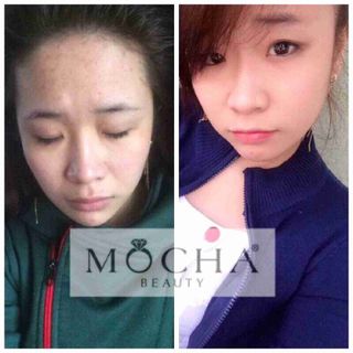 Bộ trị mụn thâm đông y mocha