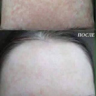Kem đặc trị nám - tàn nhang - đồi mồi thâm da mặt my miu
