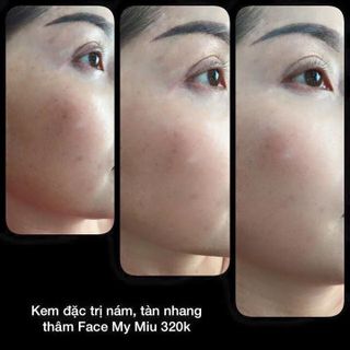 Kem đặc trị nám - tàn nhang - đồi mồi thâm da mặt my miu