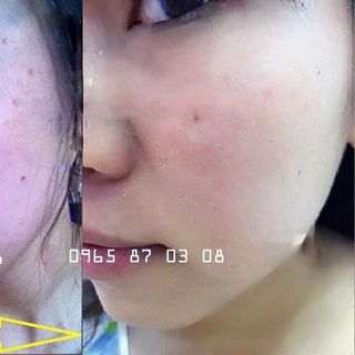 Kem trị mụn turmeric cream