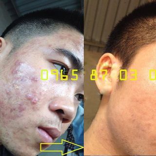 Kem trị mụn turmeric cream
