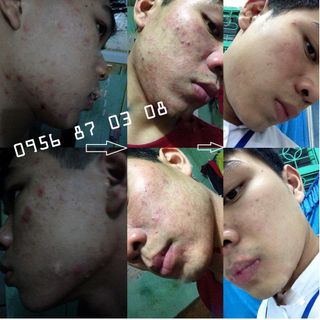 Kem trị mụn turmeric cream