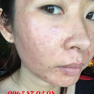 Kem trị mụn turmeric cream