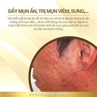 Nhũ tương dành cho da mụn da dầu