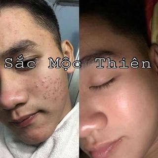 Thuốc tri mụn sắc mộc thiên