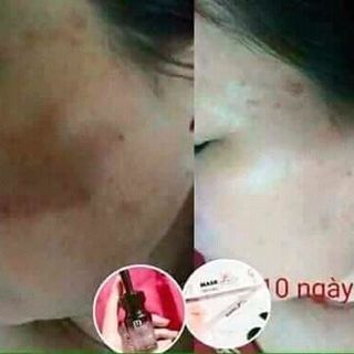 Mask botox