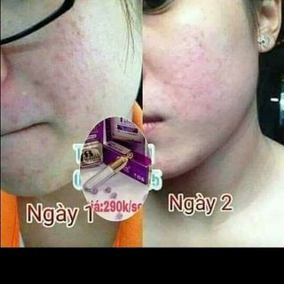 Serum trị mụn