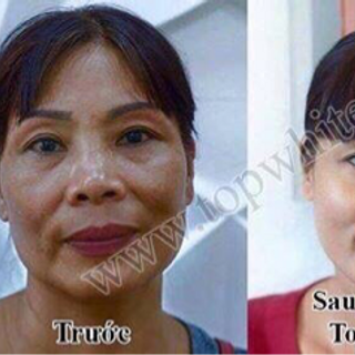 Kem trị nám topwhite d1