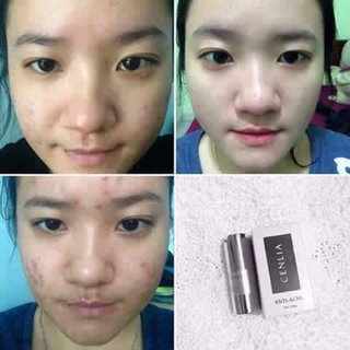 Trị mụn bán chạy nhất