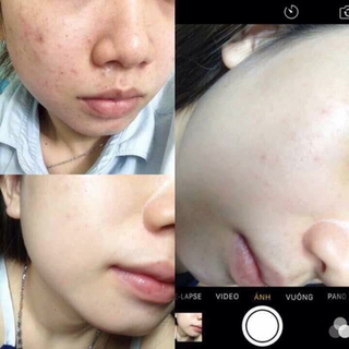 Trị mụn bán chạy nhất