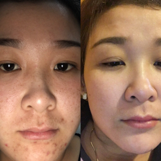 Thảo dược trị mụn