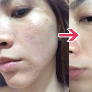 Kim lăn trị sẹo chăm sóc da demaroler zgts 540-192 đầu kim