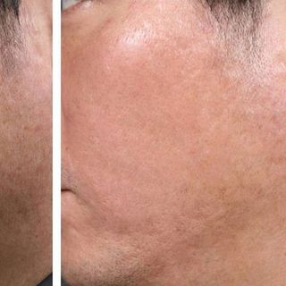 Kim lăn trị sẹo chăm sóc da demaroler zgts 540-192 đầu kim