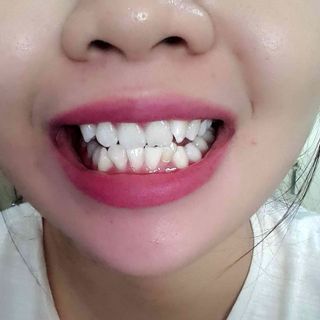 Miếng dán trắng răng crest supreme professional hàng mỹ