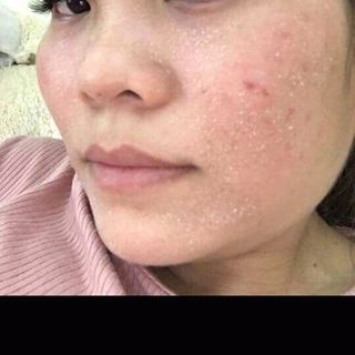 Tam trang trị mun tàn nhang
