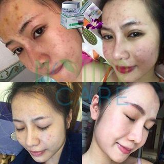 Kem trị mụn mother care