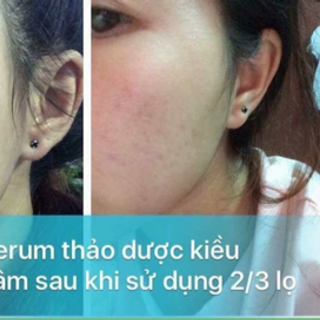 Serum thảo dược