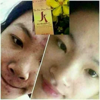 Serum trị mụn kiều beauty queen