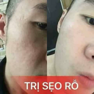 Serum trị mụn kiều beauty queen