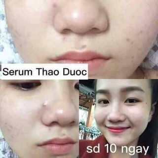 Serum trị mụn kiều beauty queen