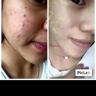 Kem trị thâmsẹo rỗnellyp