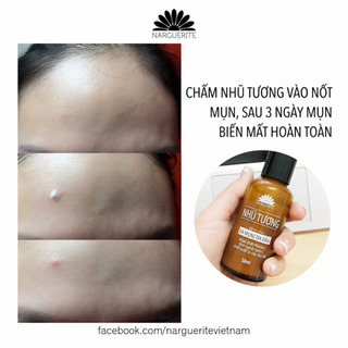 Nhũ tương trị mụn narguerite