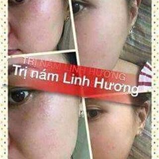 Tinh dầu trị nám tàn nhang linh hương giá sỉ