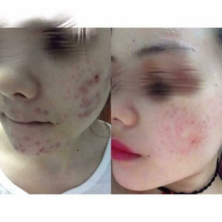 Thuốc mụn tái tạo da