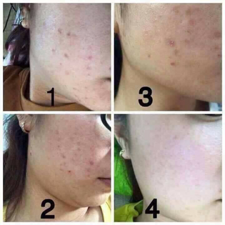 Tắm trắng trị mụn