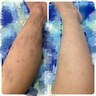 Tinh dầu trị thâm miaozy