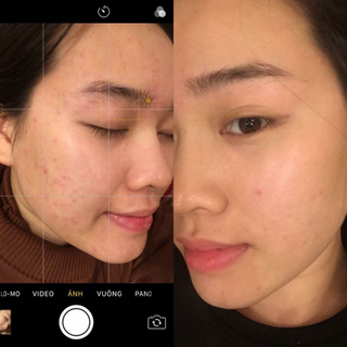 20 dayskin
