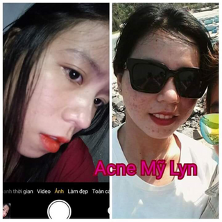 acne mỹ lyn chuyên trị mụn thần thánh