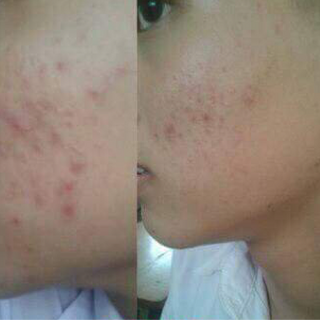 acne mỹ lyn chuyên trị mụn thần thánh