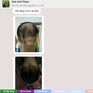 Mọc tóc tuệ lâm