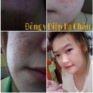 Trị mụn đông y diệp hạ châu