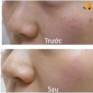 sữa ong chúa tươi tây bắc đặc trị nám đồi mồi tàn nhang mụn cám