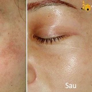 sữa ong chúa tươi tây bắc đặc trị nám đồi mồi tàn nhang mụn cám
