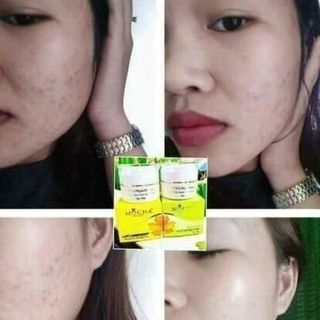 BỘ TRỊ MỤN ĐÔNG Y