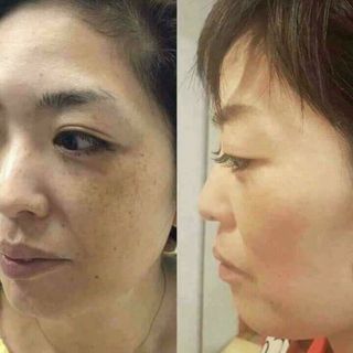 KEM ĐẶC TRỊ NÁM TÀN NHANG ĐỒI MỒI MYMIU giá sỉ