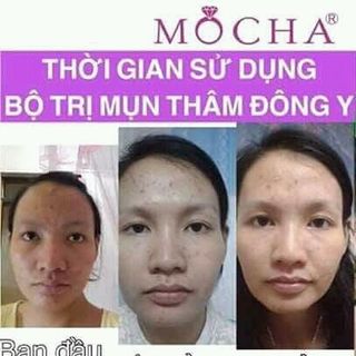 bộ trị mụn đông y mocha