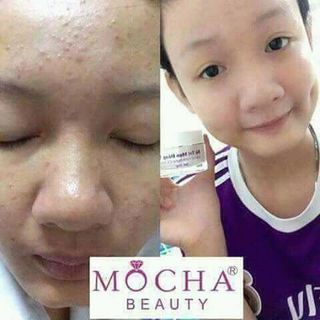 bộ trị mụn đông y mocha